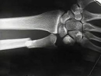 Перелом локтевой кости со смещением сроки лечения thumbnail