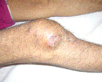 Туберкулез суставов симптомы лечение thumbnail