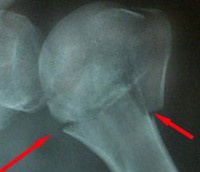 Переломы хирургической шейки плеча thumbnail