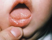 Герпетическим стоматитом 2 года ребенку thumbnail