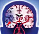 Инсульт головного мозга патологическая анатомия thumbnail