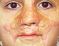 Ожог на носу с пузырем thumbnail