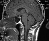 Эпилепсия и синдром арнольда киари thumbnail