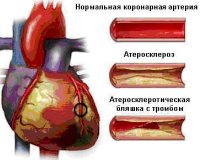 Ишемическая болезнь сердца остро коронарный синдром thumbnail