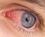 Заболевания с синдромом красного глаза thumbnail