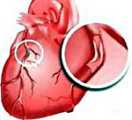 Лечение инфаркта ишемической болезни сердца thumbnail