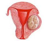 Признаки интерстициальной миомы тела матки thumbnail
