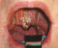 Ожог слизистой рта и горла лечение thumbnail