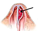 Абсцесс или гематома носовой перегородки thumbnail
