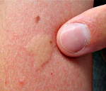 Аллергия на лице от насекомых thumbnail