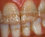 Общее лечение постлучевого некроза твердых тканей зубов применяют thumbnail