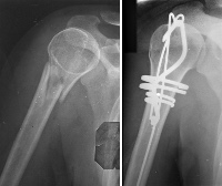 История болезни перелом плечевой кости у детей thumbnail