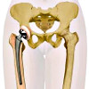 Клиника на соколе замена сустава тазобедренного