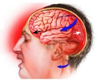 Черепно мозговая травма сотрясение и ушибы головного мозга thumbnail