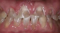 Кислотная эрозия зубов лечение thumbnail