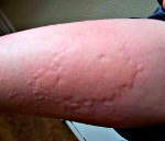 Проверка на аллергию на пенициллин thumbnail