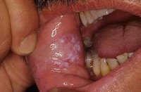 Кандидоза слизистых оболочек рта лечение thumbnail