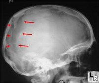 Ушиб головного мозга перелом затылочной кости thumbnail