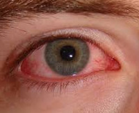 Синдром красного глаза что это такое thumbnail
