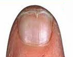 Ломкие ногти на ногах лечение thumbnail