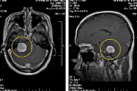 Синдромы при раке головного мозга thumbnail