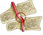 Синдром позвоночной артерии и климакс thumbnail