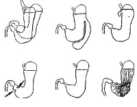 Врожденные пороки развития желудочно кишечного тракта у новорожденных thumbnail